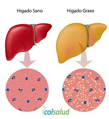 ¿El Azúcar Causa Inflamación en el Cuerpo? 6 azúcar causa inflamación El Azúcar Causa Inflamación en el Cuerpo - Hígado Graso